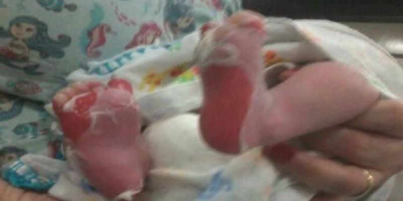 LAMENTÁVEL - Bebê tem pernas e pés queimados após banho em Hospital no interior da Paraíba