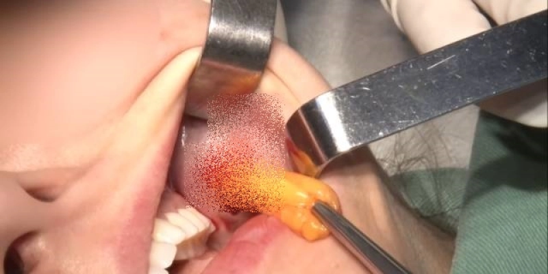 Cirurgião Plástico, Dr. Paulo José, explica procedimento bichectomia e a diminuição das bochechas