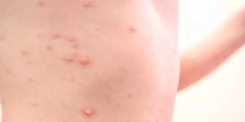 Mpox: OMS pede resposta após registro de nova variante na Suécia