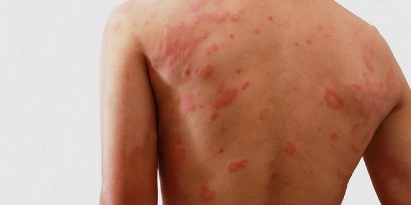 Paraíba reduz novos casos de hanseníase, mas números da doença ainda preocupam