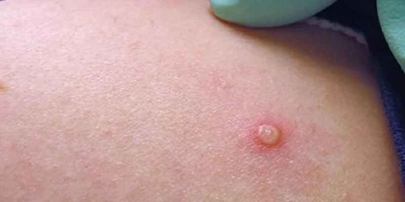 Região Norte do Brasil registra casos de mpox