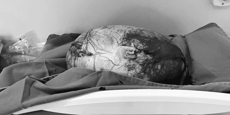 Hospital Regional de Guarabira realiza cirurgia de urgência para retirada de cisto ovariano gigante