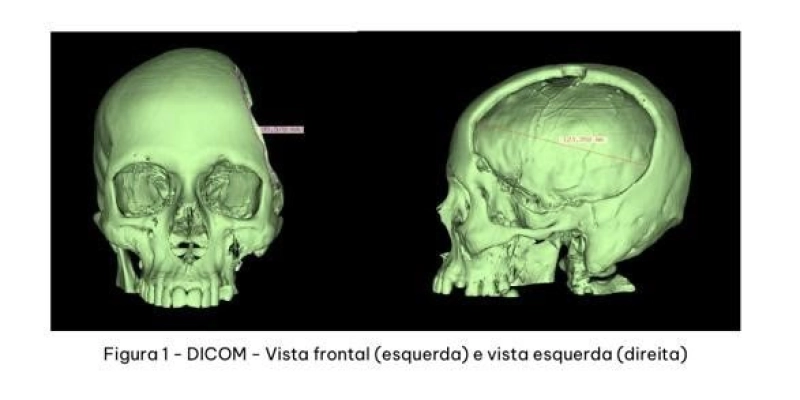 Hospital Metropolitano realiza primeira reconstrução de crânio utilizando prótese feita sob medida com modelo 3D