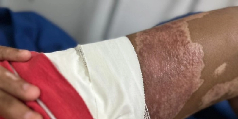 Hospital de Trauma de João Pessoa alerta para aumento de acidentes com queimaduras no fim de ano