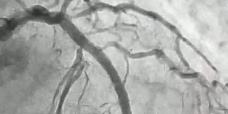 Hemodinâmica de Patos realiza procedimento cardiovascular de alta complexidade inédito no Sertão da Paraíba 