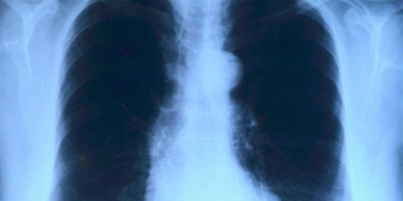 Anvisa aprova nova combinação de drogas para câncer de pulmão
