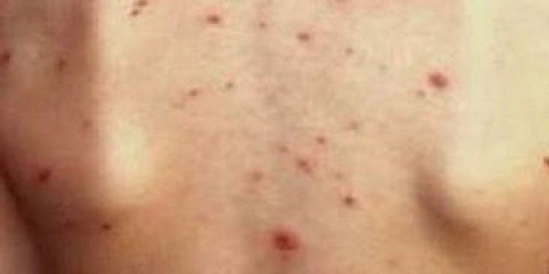 Campanha de Vacinação contra Poliomielite e Sarampo começa na próxima segunda-feira