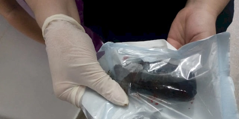 Mulher passa por cirurgia para retirada de droga escondida no ânus em Cajazeiras