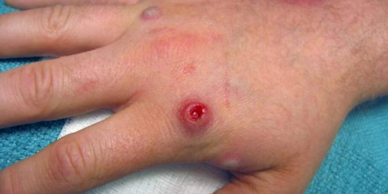 Paraíba amplia serviços do Alô Saúde para Monkeypox