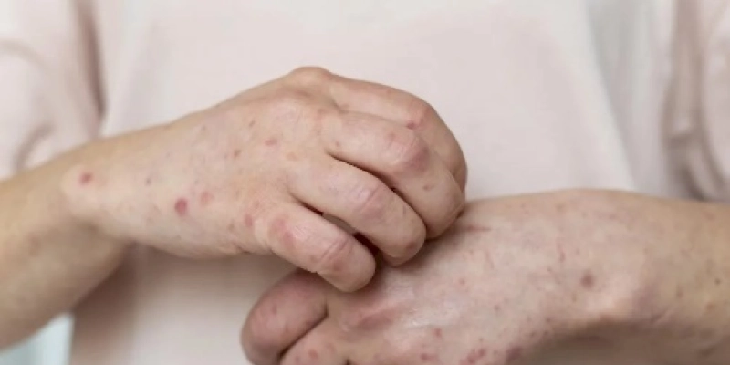 Casos de mpox sobem para 105 na Paraíba