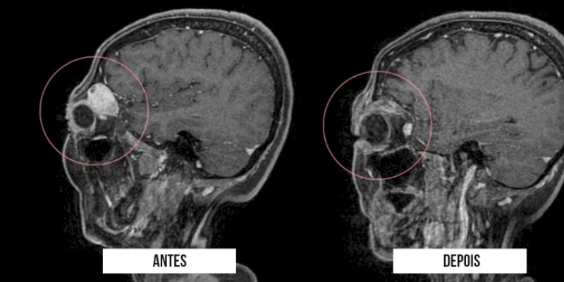 Equipe de Neurocirurgia inova na remoção de tumor com técnica endoscópica, em paciente sousense 