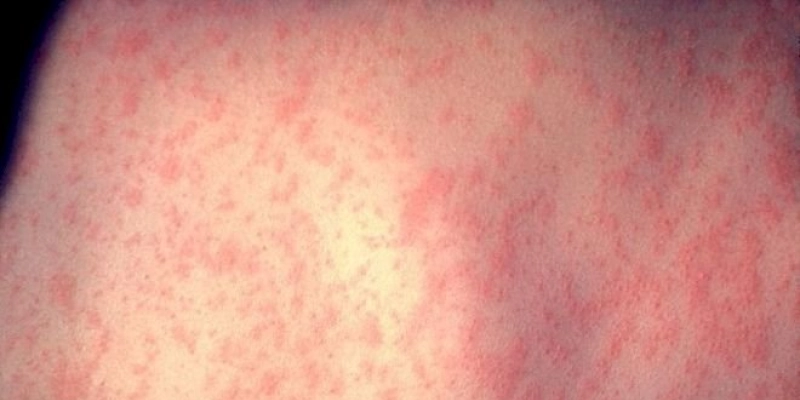 Sarampo: Paraíba alerta para importância da vacinação como medida preventiva para novos surtos 