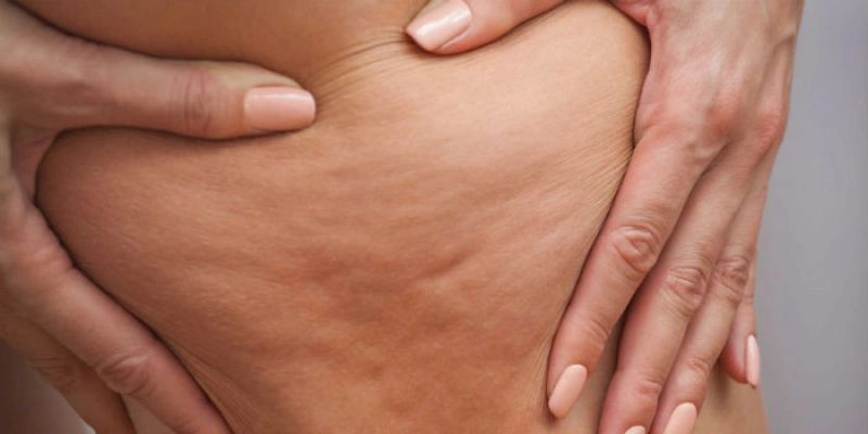 Celulite afeta oito em cada dez mulheres; Saiba evitar