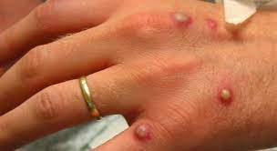 Casos de mpox no Brasil