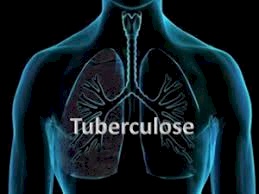Tratamento contra a tuberculose multirresistente