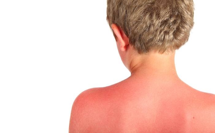 Prevenção a insolação nas crianças