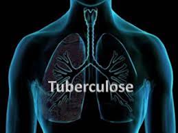 Tuberculose