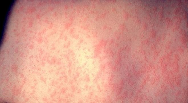 Sarampo: Paraíba alerta para importância da vacinação como medida preventiva para novos surtos 