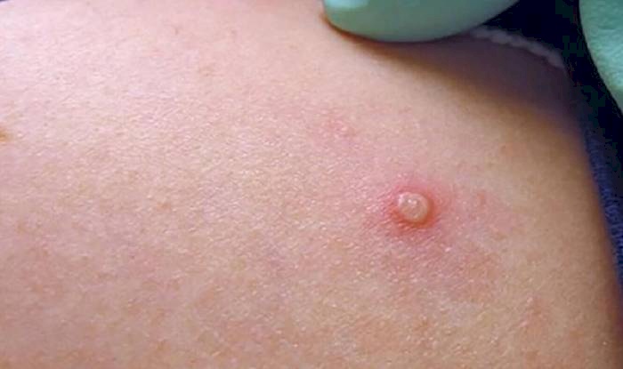 Primeiro lote importado de vacinas contra a Monkeypox