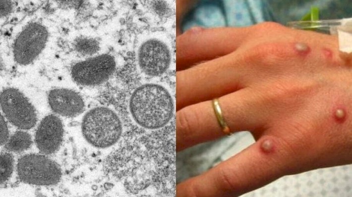 A secretária chama atenção para as medidas de proteção e que evitam a transmissibilidade da monkeypox