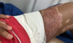 Atendimento às vítimas de queimaduras