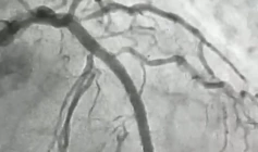 Hemodinâmica de Patos realiza procedimento cardiovascular de alta complexidade inédito no Sertão da Paraíba 