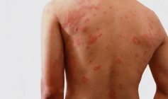 Janeiro Roxo alerta para prevenção, diagnóstico precoce e combate ao preconceito da hanseníase