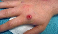 Casos confirmados de Mpox