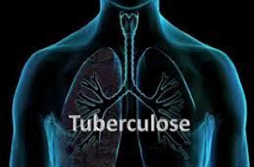 Imagem Tuberculose