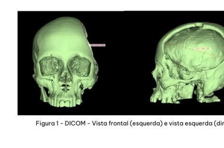 Imagem Reconstrução de crânio utilizando prótese feita sob medida com modelo 3D
