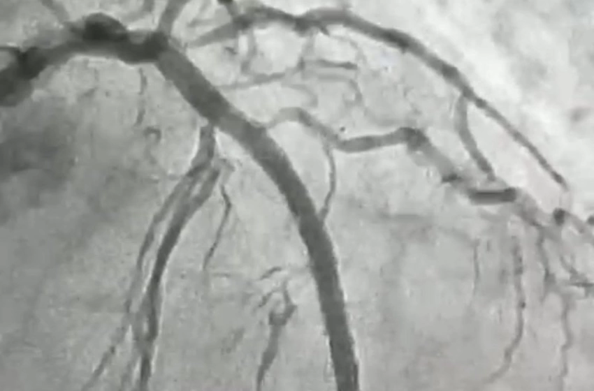 Imagem Hemodinâmica de Patos realiza procedimento cardiovascular de alta complexidade inédito no Sertão da Paraíba 