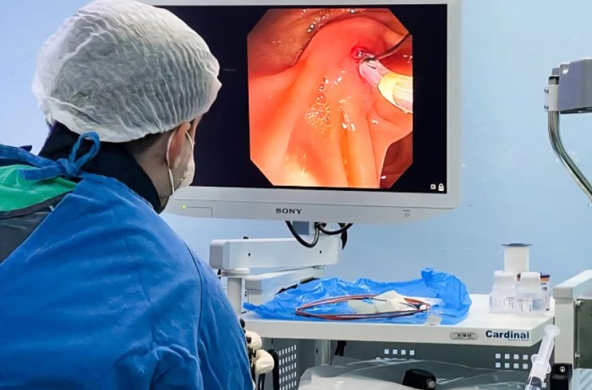 Imagem Primeira ressecção endoscópica de tumor precoce de reto