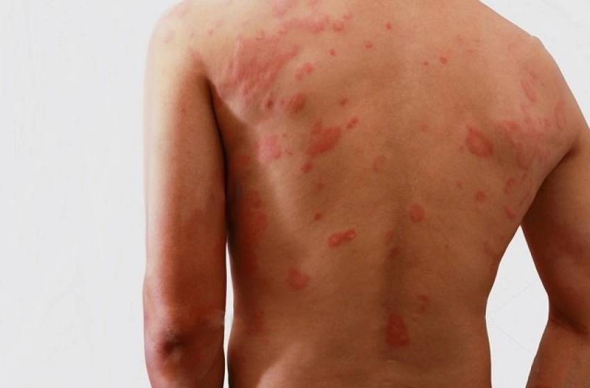 Imagem Janeiro Roxo alerta para prevenção, diagnóstico precoce e combate ao preconceito da hanseníase