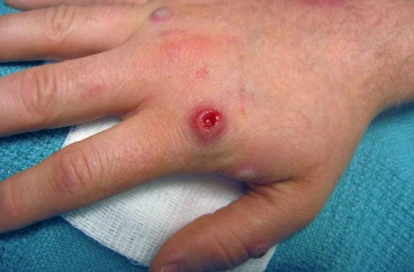 Imagem Casos confirmados de Mpox