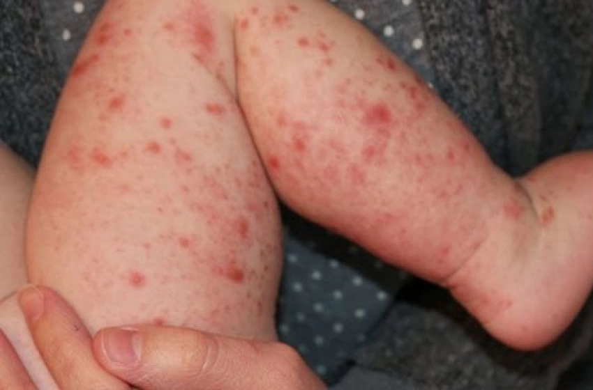 Imagem Aumento do sarampo nas Américas