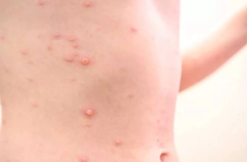 Imagem Varíola do macaco