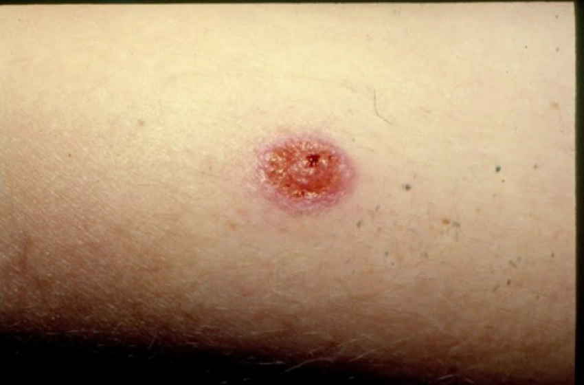 Imagem esporotricose humana