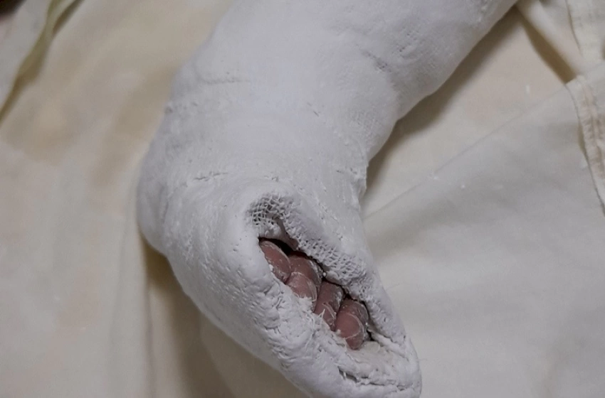 Imagem Além das cirurgias para correção do pé torto congênito, o Opera Paraíba também realiza no hospital cirurgias ortopédicas de mão