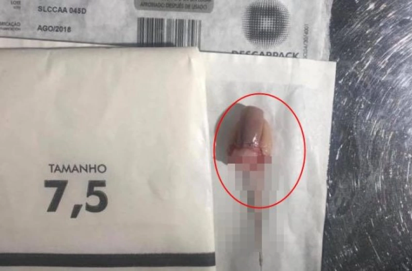 Imagem Dedo decepado